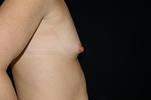 Breast Augmentation 6c